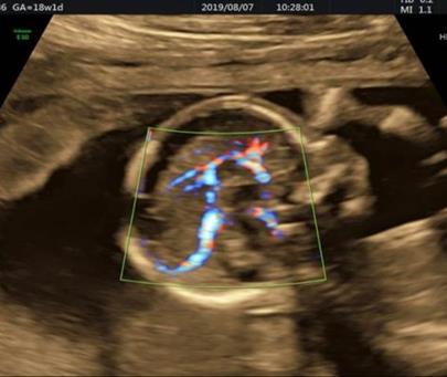 سونوگرافی جامع سه ماهه دوم بارداری (آنومالی اسکن)